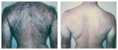 LASER HAIR REMOVAL - Man's Back
